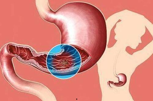 医生爆料切胃胃癌的视频,医生亲述惊心动魄的救治历程  第3张 医生爆料切胃胃癌的视频,医生亲述惊心动魄的救治历程  第3张